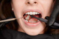 carie-dentaire-dus-aux-microbes-et-champignons-dentiste-paris-17