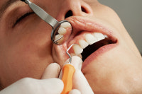 Les gouttières de fluoration : Dentiste Paris 17